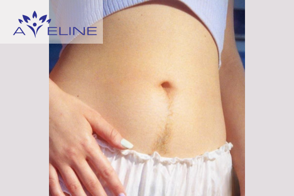 why-do-girls-have-belly-hair